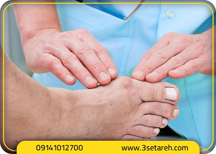 نکاتی برای پیشگیری از تشدید هالوکس والگوس